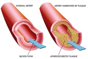 atherosclerosis